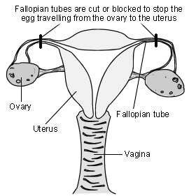 Diagram of the female reproductive organs showing how female sterilisation is performed