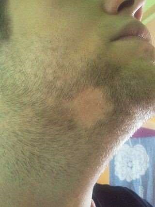 Alopecia areata beard area