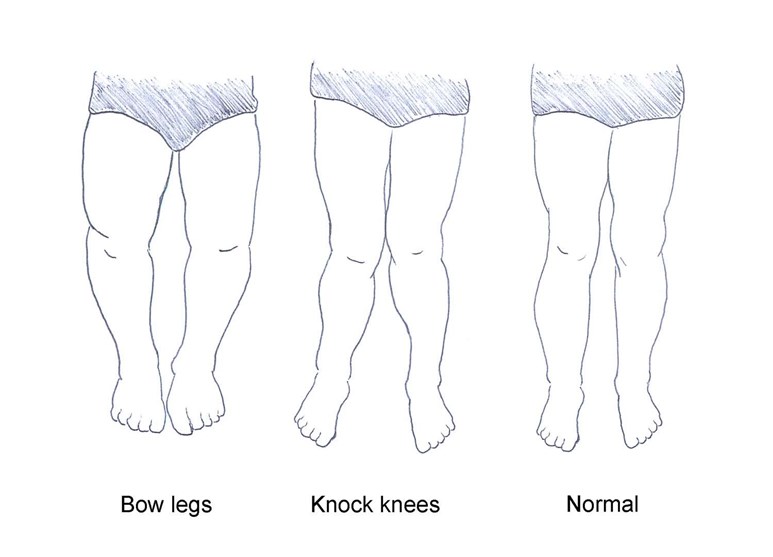 Diagram of bow legs and  knock knees 