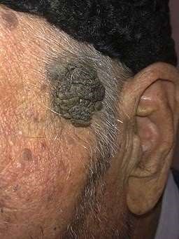Black pigmented verrucous lesion