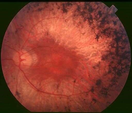 Fundus of patient with retinitis pigmentosa, mid stage