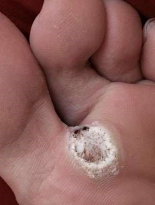 Sole of foot verruca