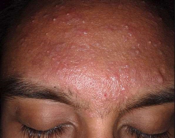 Mild acne on forehead