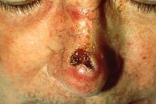 Squamous cell carcinoma - nose