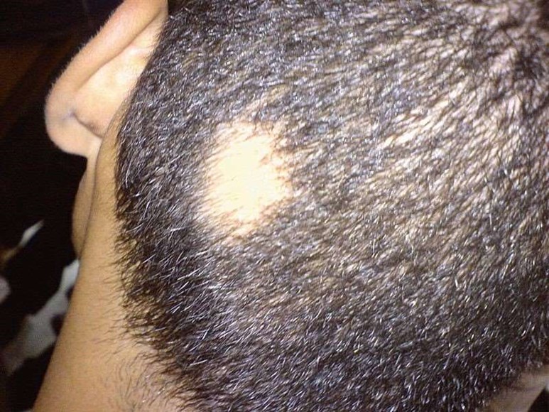 Alopecia areata on back of head