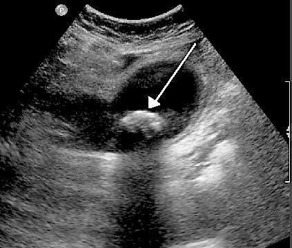 Gallstone ultrasound image