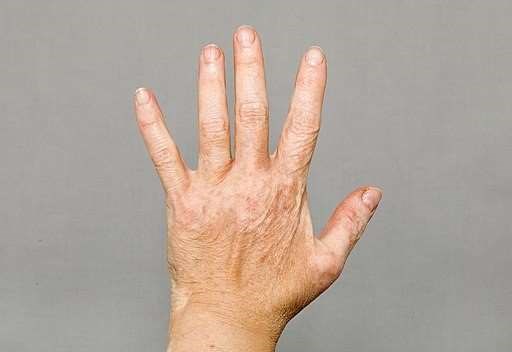 Vitiligo on left hand
