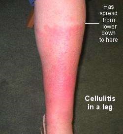 CELLULITIS IN LEG