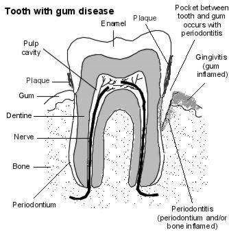 tooth with gum disease
