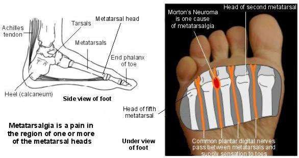 Metatarsalgia (Metatarsal Injury) | Causes and Treatment | Patient