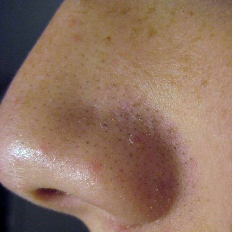 Blackheads on the nose