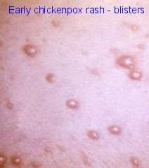chickenpox blisters