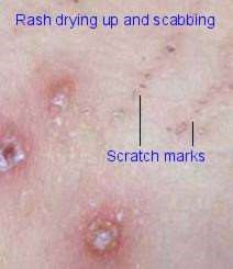 chickenpox scabbing