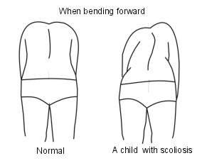 scoliosis diagnosis