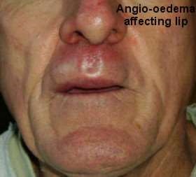angiooedema of lip