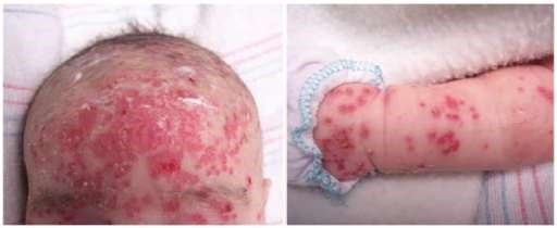 Eczema Herpeticum Causes And Treatment Patient