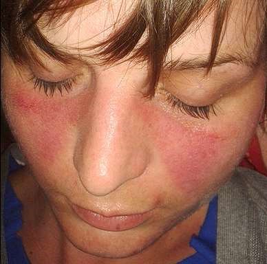 The butterfly rash of lupus