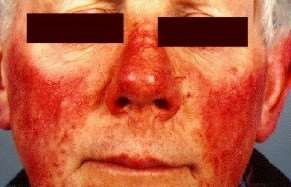 Rosacea on nose and cheeks