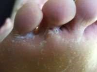 skin cracking between toes