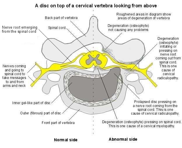 Cervical vertebra (Beverley Kenny)