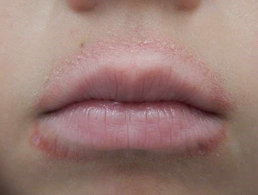 Lip-licking dermatitis
