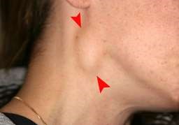 Tonsillitis symptoms lymph nodes