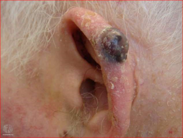 Nodular melanoma on an ear