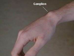Ganglion of wrist