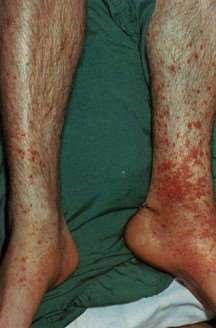 purpuric rash of HSP
