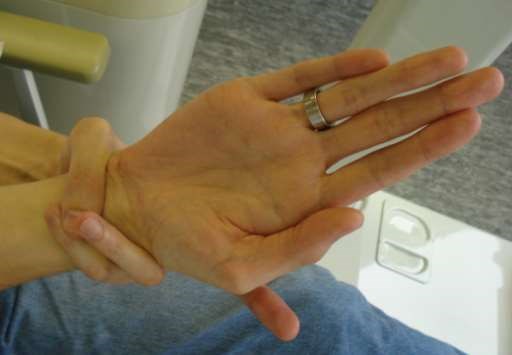 Marfan syndrome wrist sign
