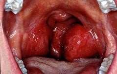 swollen tonsils with white spots and swollen glands