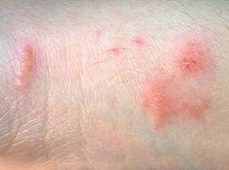 Contact dermatitis caused by poison ivy