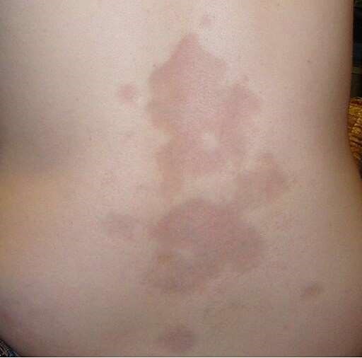 Morphea located on the back of a 16 year old Caucasian woman