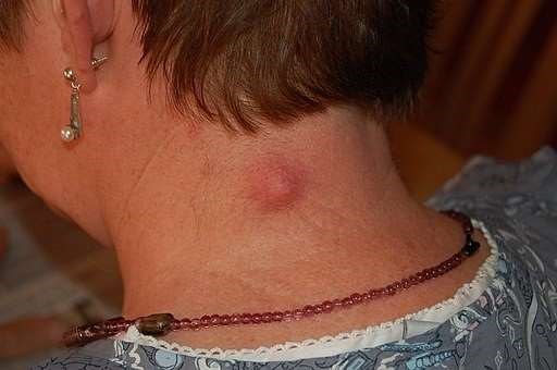 Epidermoid cyst on the neck