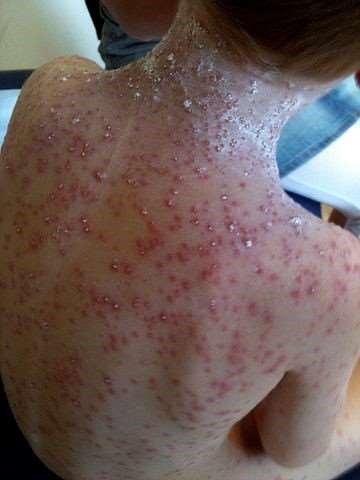 Severe chickenpox