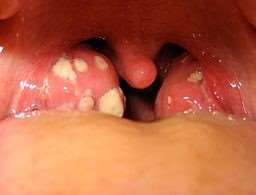 Tonsillitis symptoms