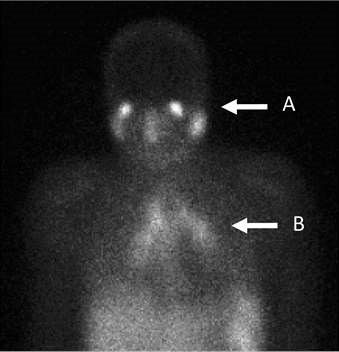 Gallium scan image