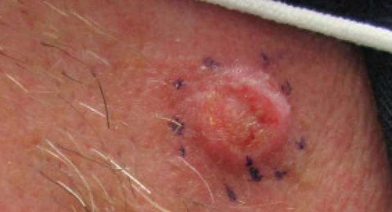 Squamous cell carcinoma - cheek