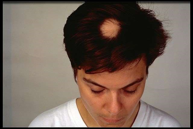 Alopecia areata on a woman's head