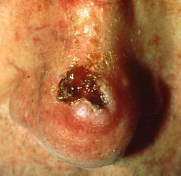 Squamous cell carcinoma on the tip of the nose