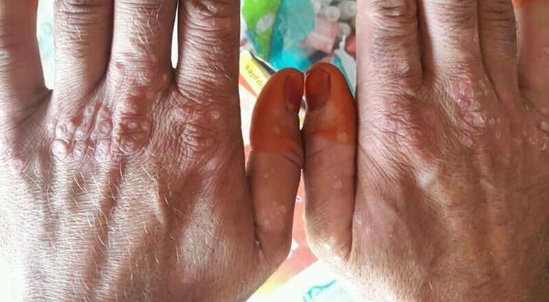 Guttate psoriasis hands