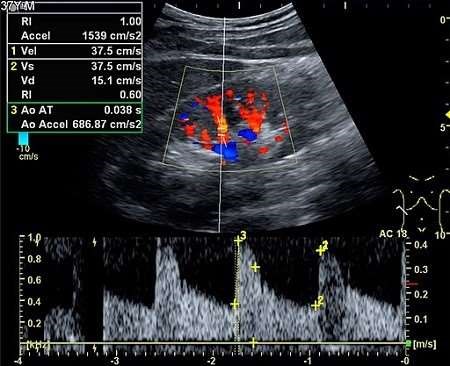 Kidney ultrasound scan