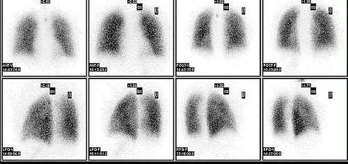 Lung perfusion scan