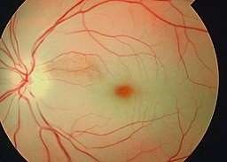 Cherry red spot and retinal swelling of central retinal artery occlusion.