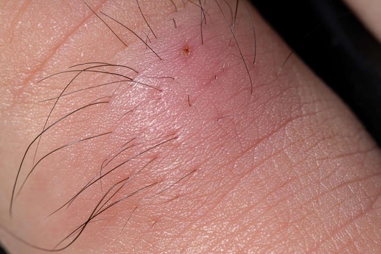 Ingrown Hair  Causes Symptoms Complications Diagnosis Treatment and  Prevention