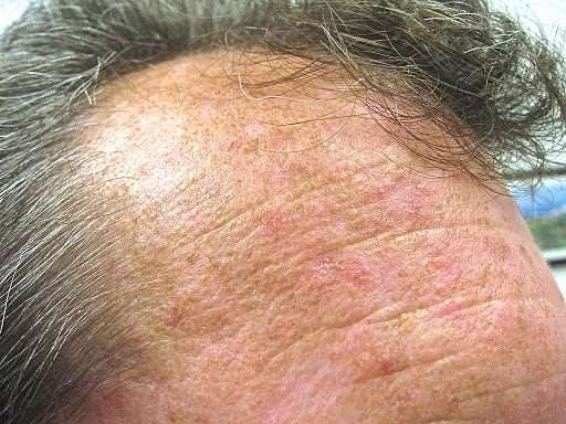 Actinic keratoses on forehead