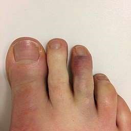 Broken Toe: Symptoms and Treatment Patient