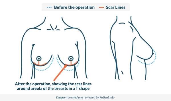 Breast reduction new