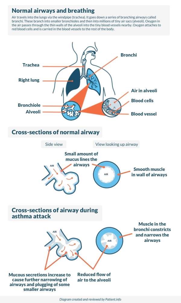 Asthma diagram new