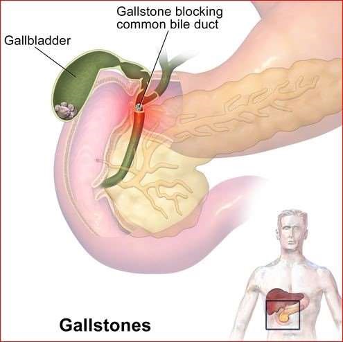 Gallstone blockage
